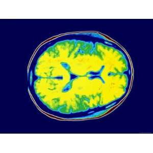 Normal MRI Head Transverse Magnetic Resonance Image Photographic 